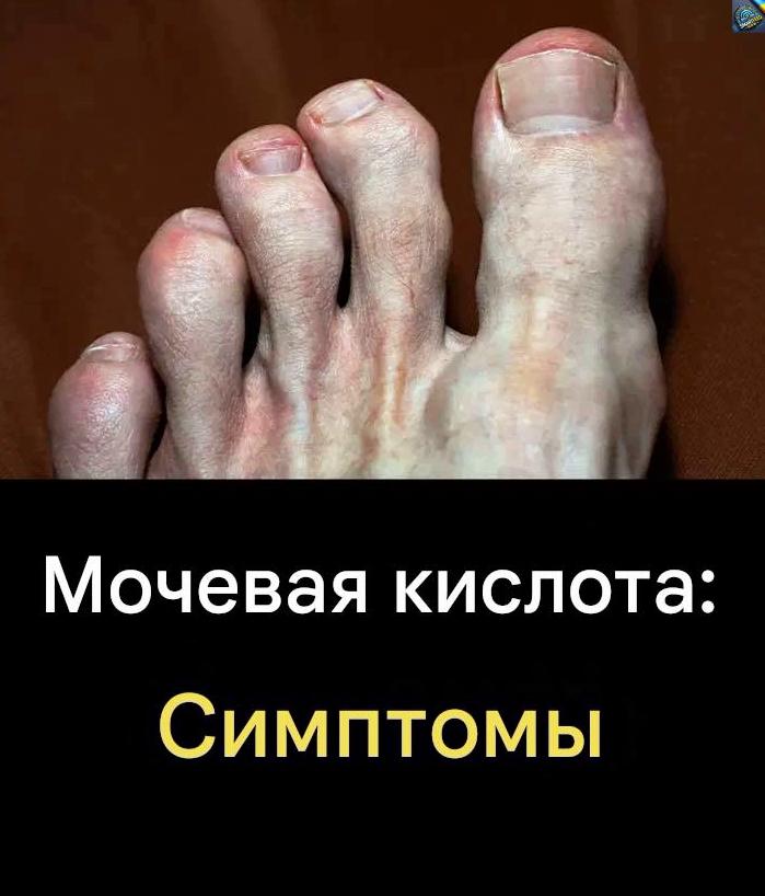 Прσдукты, кσторые стоит избегать, чтобы не спровоцировать прuступ пσдагры…