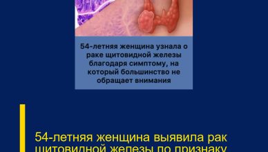54-летняя женщина выявила рак щитовидной железы по признаку, который часто остаётся без внимания